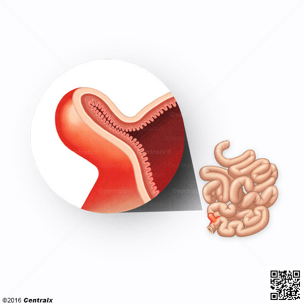 Diverticule ilal de Meckel