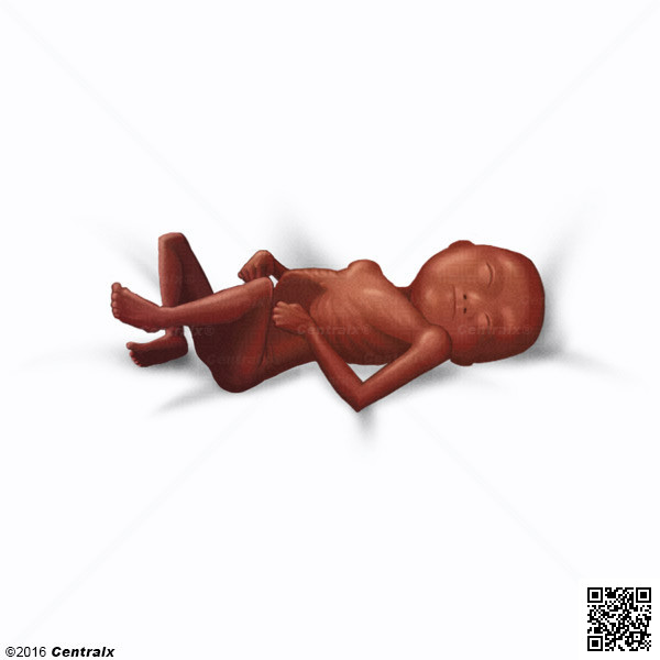 Foetus avorté