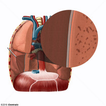 Cavité pleurale