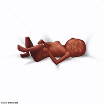 Foetus avorté